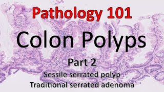 Colon Polyps  Part 2  Pathology 101 [upl. by Adniuqal]