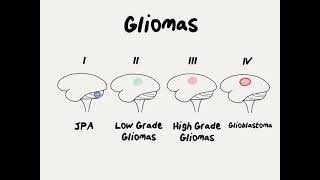 Doctor Explains Glioma Brain Tumor [upl. by Soneson346]