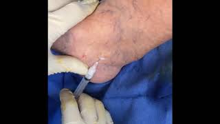 Sclerotherapy  Spider Veins Treatment at Vein Health Vein Clinic [upl. by Niltac]