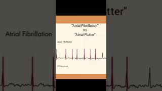 Arterial fibrillation vs arterial flutter eassy way to learn aiims doctor nursingofficer cardio [upl. by Aicxela]