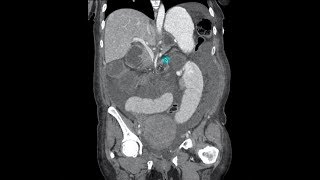 Computed Tomography Imaging Findings for Internal Hernia [upl. by Peyter]