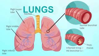 How do you know if you have bronchitis [upl. by Neehsuan97]