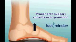 Foot Pain Due to Flat Feet and OverPronation An Easy Solution [upl. by Enerak]