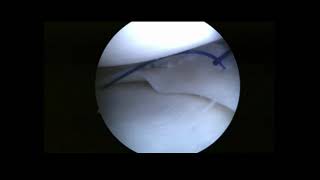 OutsideIn Single–Lasso Loop Technique for Meniscal Repair Fast Economic and Reproducible [upl. by Leba]