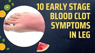 10 Early Stage Blood Clot Symptoms In Leg [upl. by Kendrah]