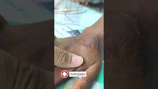 ENCHONDROMA small bone tumour ftDr Irfan Siddiqui bonetumourorthopedictreatment doctor हड्डी [upl. by Capello]