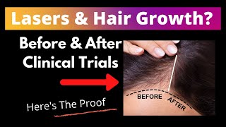 Laser Therapy amp Hair Growth Proof amp Side Effects [upl. by Postman202]