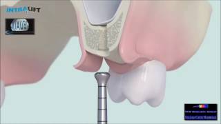 transcrestal Sinuslift INTRALIFT  surgical protocol [upl. by Tharp]