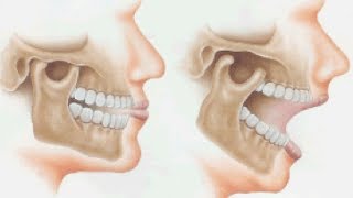 Orthotropic Treatment of Jaw JointTemporomandibular Disorder TMD by Dr Mike Mew [upl. by Newmann]