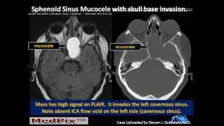 Sphenoid Sinus Mucous Retention Cyst vs Mucocele correction Slide 5 [upl. by Rolecnahc]