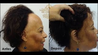 Prótese Capilar Frontal  De Cheveux 11 25945137 [upl. by Aenert915]