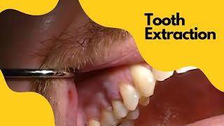 Extraction Tooth 4  Severe Angulation of the root AND a fracture using Physics Forceps [upl. by Ochs]