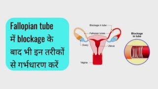 Fallopian tube blockage causes symptoms and treatment fallopiantubeblockage fallopiantube [upl. by Corabelle]