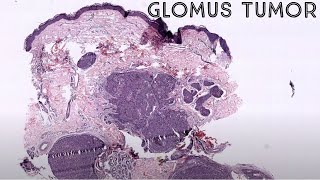 Glomus tumor under the microscope pathology dermpath dermatology dermatopathology [upl. by Brigham]