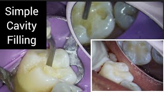 Small Cavity Composite Restoration under Dental Operating Microscope  Simple Class 1 Filling [upl. by Otrebile523]