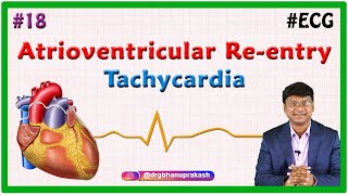 18 Atrioventricular Reentry Tachycardia amp Atrioventricular Nodal Reentrant Tachycardia [upl. by Lauren]