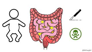 Necrotizing Enterocolitis [upl. by Yalonda]