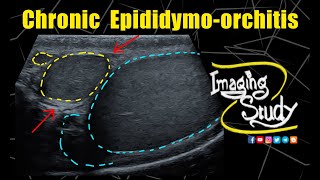 Chronic Epididymoorchitis  Ultrasound  Case 328 [upl. by Assenev]