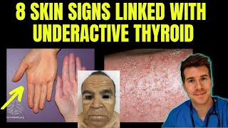 Doctor explains 8 SKIN SIGNS linked with HYPOTHYROIDISM aka underactive thyroid [upl. by Yllaw782]