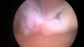 Removal of a large fundal polyp using a hysteroscopic morcellator [upl. by Ihcego434]