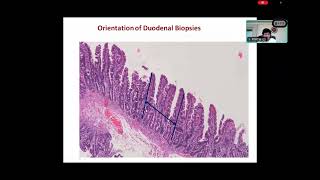 KIDNEY BIOPSY INTERPRETATION  GLOMERULAR LESIONS [upl. by Donald]