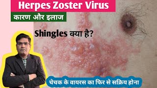 Herpes Zoster Shingles Disease Cause Symptoms and Treatment in Hindi  Varicella Zoster Virus [upl. by Cyndie]