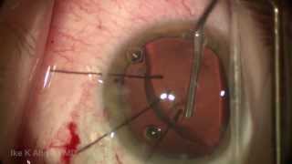 Capsular Tension Segment CTS Surgical Technique for Dislocated Cataract by Ike Ahmed [upl. by Jat]