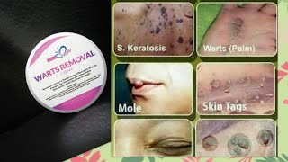 HOW TO GET RID OF WARTS  WART REMOVAL CREAM [upl. by Ymaral]