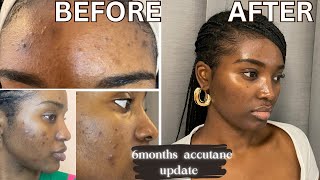 GETTING RID OF ACNE amp HYPERPIGMENTATION  6 MONTHS ACCUTANE UPDATE  ACCUTANE JOURNEY [upl. by Weld548]