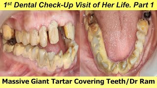 Part 1  Teeth Covered by Massive Tartar Teeth 😱Teeth whitening 😵‍💫I पायरिया का इलाजI Dr Ram MDS [upl. by Ursuline]