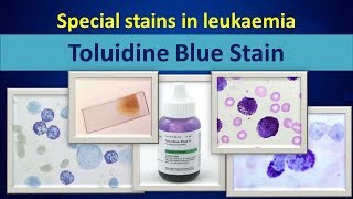 Toluidine blueSpecial stain in leukaemia [upl. by Kristy]