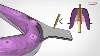 NucleOSS T6 Implant  Vidalı Çözümler  Açık Kaşık Ölçü Parçaları  Kullanım TR [upl. by Penny]