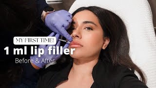 I GOT LIP FILLERS FOR THE FIRST TIME  1ML [upl. by Eixirt]