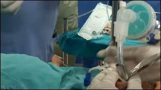 Endotracheal intubation with intubating LMA [upl. by Mcmullan]