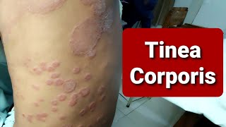 Tinea Corporis  WideSpread [upl. by Egiedan]