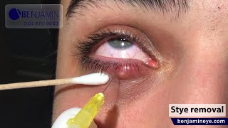 Styes may require surgical intervention to drain the pus and alleviate pressure on the eyelid [upl. by Hillari]