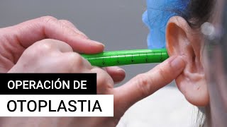 Operación de otoplastia  CEME [upl. by Fayina536]