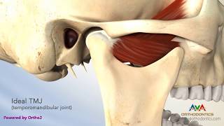 TMJ Disorder or TMD  Clicking and Closed Lock [upl. by Enaid]