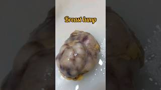 Breast lump excision biopsy for histopathology😨 breastcancer breastdisease breastfeeding lump [upl. by Ysdnyl]