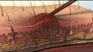 inflammatory reaction in 3D animation [upl. by Reid]