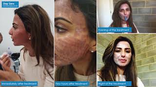 CO2 Laser Resurfacing treatment at London Laser Clinic [upl. by Esnofla896]