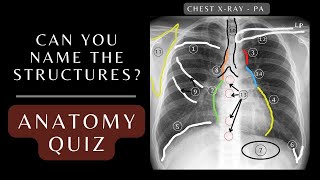 Chest Xray Anatomy Quiz Questions and Answers  Chest Xray Anatomy xray respiratory [upl. by Ahseym]