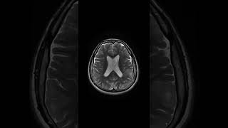 Tuberous sclerosis mribrain shoets [upl. by Lugo976]