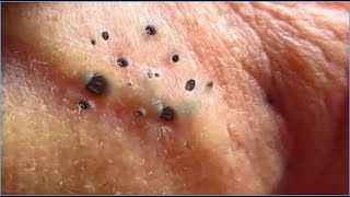 Pimple Popping Blackheads On Skin 😲😲 [upl. by Natsrik]