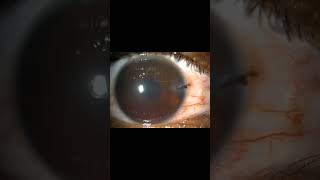 IntraocularForeignBodyCornealLacerationHyphemaIrisTearSomasundaramEyeHospitalKarur [upl. by Eardnoed]