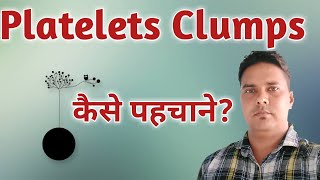 Platelets Clumps कैसे पहचाने  Platelet clumps on smear  Platelet clumps seen [upl. by Tyler]