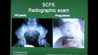 Slipped Capital Femoral Epiphysis SCFE [upl. by Leelaj134]