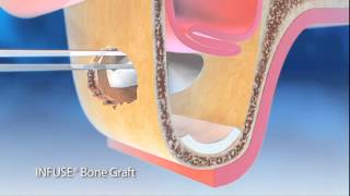 How Bone Graft Works 2 [upl. by Iorgo536]