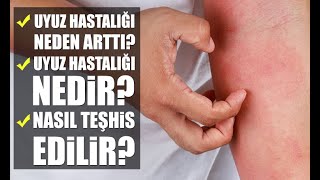 Uyuz hastalığı nedir bulaşıcı mıdır Belirtileri ve tedavi yöntemi hakkında bilmeniz gerekenler [upl. by Neram926]