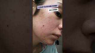 3 steps to clear cloggedpores [upl. by Berton438]